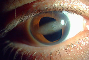 Band Keratopathy