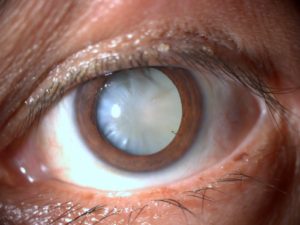 Cataract – Patient with a Dilated Eye