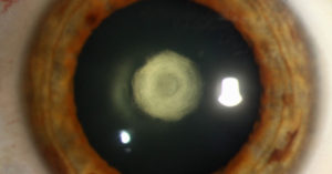 Cataract – Posterior Polar – Patient with a Dilated Eye