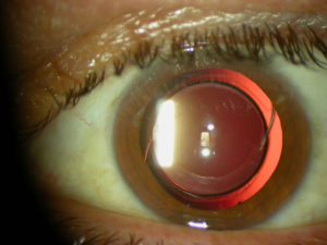Intraocular Lens – Patient with a Dilated Eye
