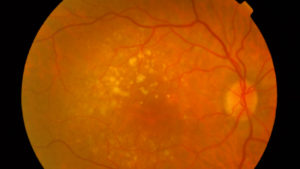 Macular Degeneration – Dry