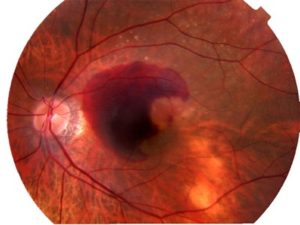 Macular Degeneration – Wet