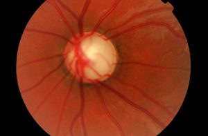 Optic Nerve – Glaucoma