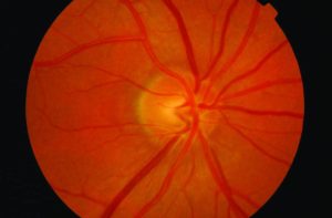 Optic Nerve – Normal