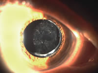 Posterior Capsular Opacity – Secondary Cataract
