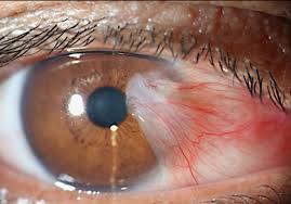 Pterygium