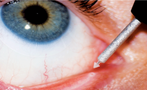 Punctal Plug
