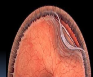 Retinal Dialysis
