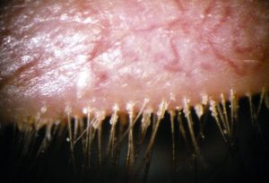 Extreme macro of an eyelid margin with crusting around the eyelashes from blepharitis
