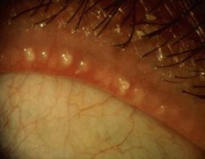 Macro view of the eyelid margin showing meibomian gland dysfunction