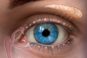 Close-up of a blue eye with a diagram illustrating the tear duct and punctal plug
