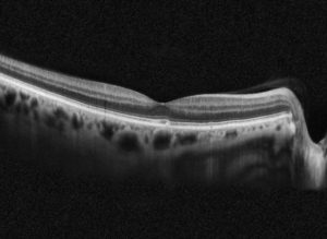 Grayscale OCT cross-sectional scan showing the layers of the retina