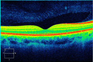 Color-coded OCT macular scan showing the central foveal dip