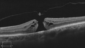 Grayscale OCT scan revealing traction at the macula