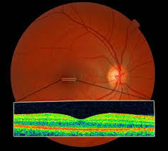 Color fundus photograph of the retina with a corresponding OCT scan strip below